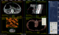 ​医院医学影像PACS系统源码，三维多平面重建、三维容积重建、心脏动脉钙化分析