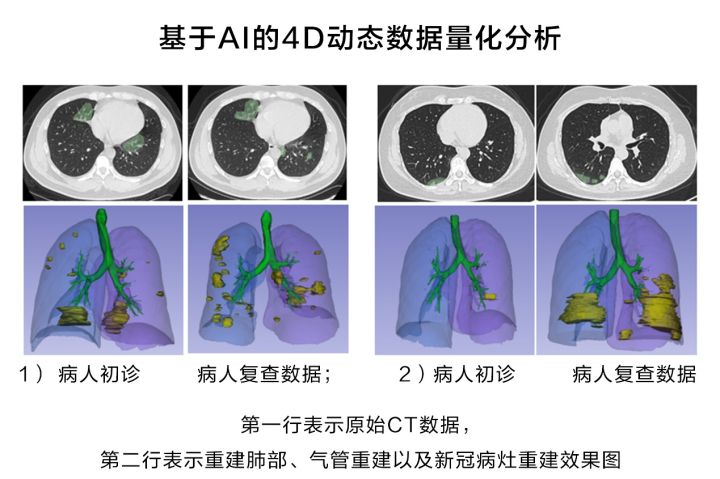 华为云推出新冠肺炎AI辅助诊断服务，CT量化结果秒级输出_华为云_02