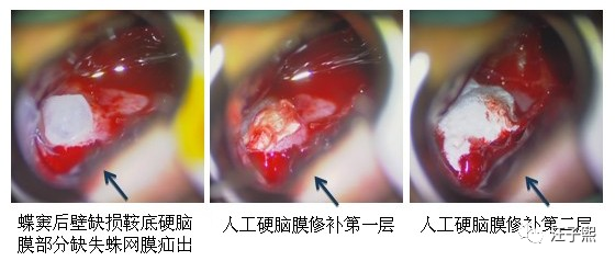 计算机世界的虚拟机容器和医学界的人工硬脑膜