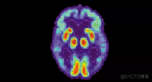 以阿尔兹海默症为例：深度解析AI+慢病商业模式_人工智能_02