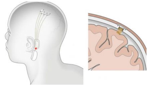 如何评价伊隆·马斯克创办的脑机接口公司 Neuralink ？_人工智能_16