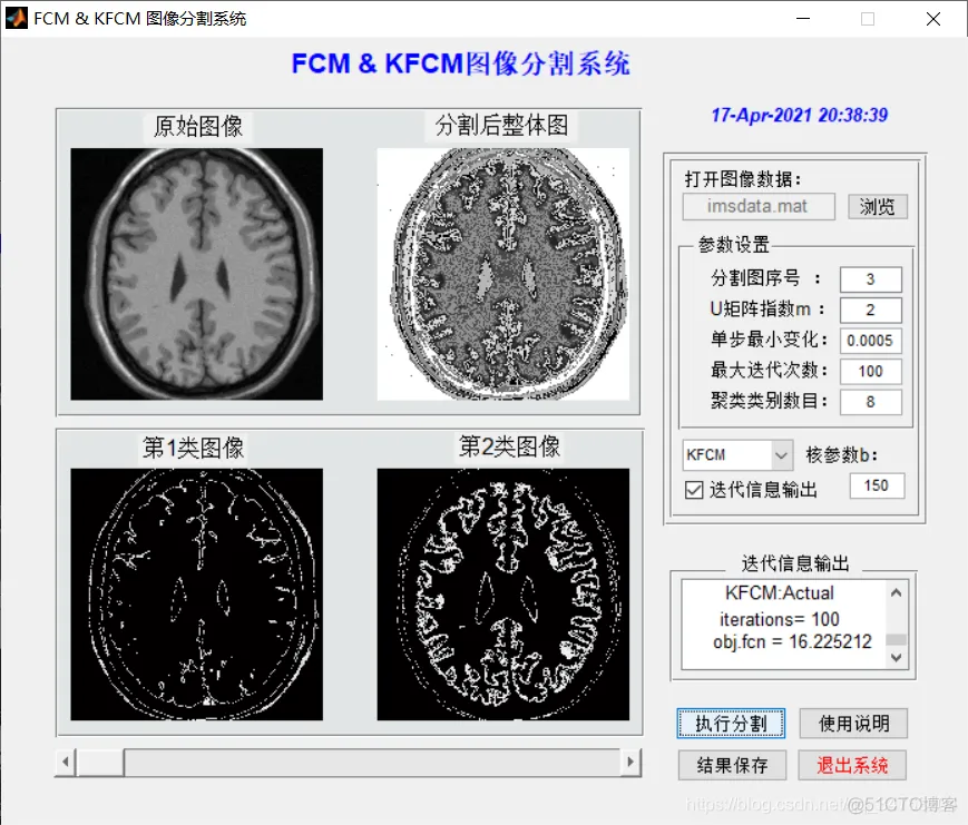 【图像分割】基于FCM和KFCM算法医学图像分割matlab源码含GUI_matlab_14