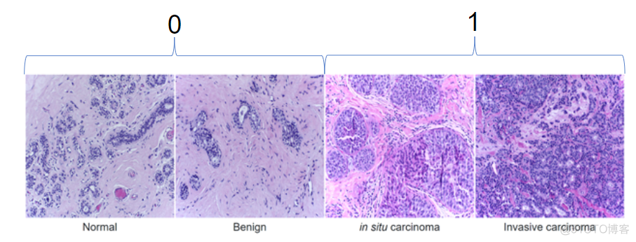 图像分类在乳腺癌检测中的应用_图像分类在乳腺癌检测中的应用_04