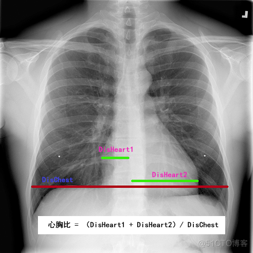如何使用PaddleSeg 2.0快速测量心胸比？_深度学习_02
