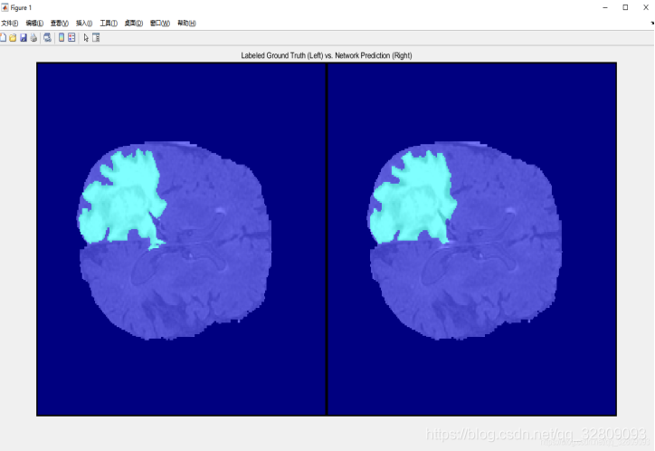 基于Matlab深度学习（Deep Learning）的3-D U-Net 神经网络进行3-D脑部肿瘤(MRI)的分割及三维重建_Matlab_10