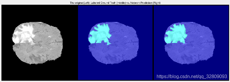 基于Matlab深度学习（Deep Learning）的3-D U-Net 神经网络进行3-D脑部肿瘤(MRI)的分割及三维重建_神经网络_11