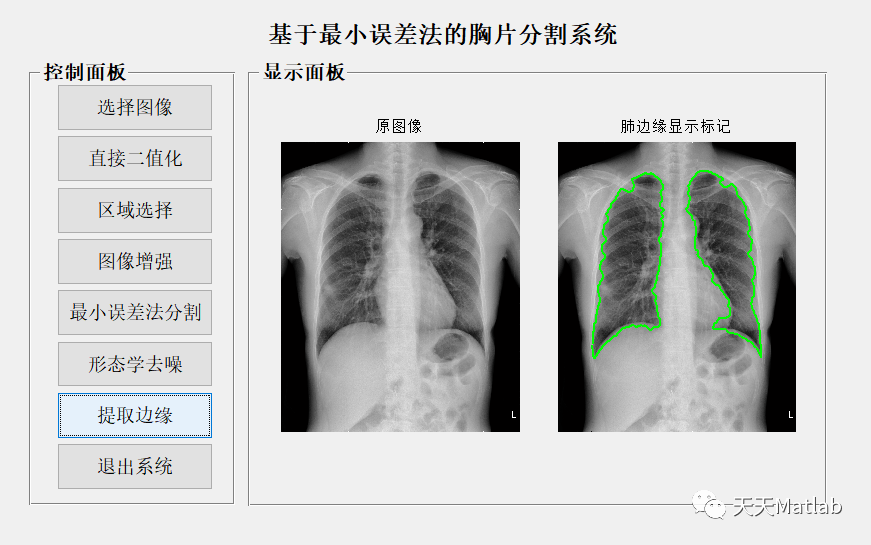 ​【图像分割】基于最小误差法实现胸片分割系统matlab代码_参考文献_04