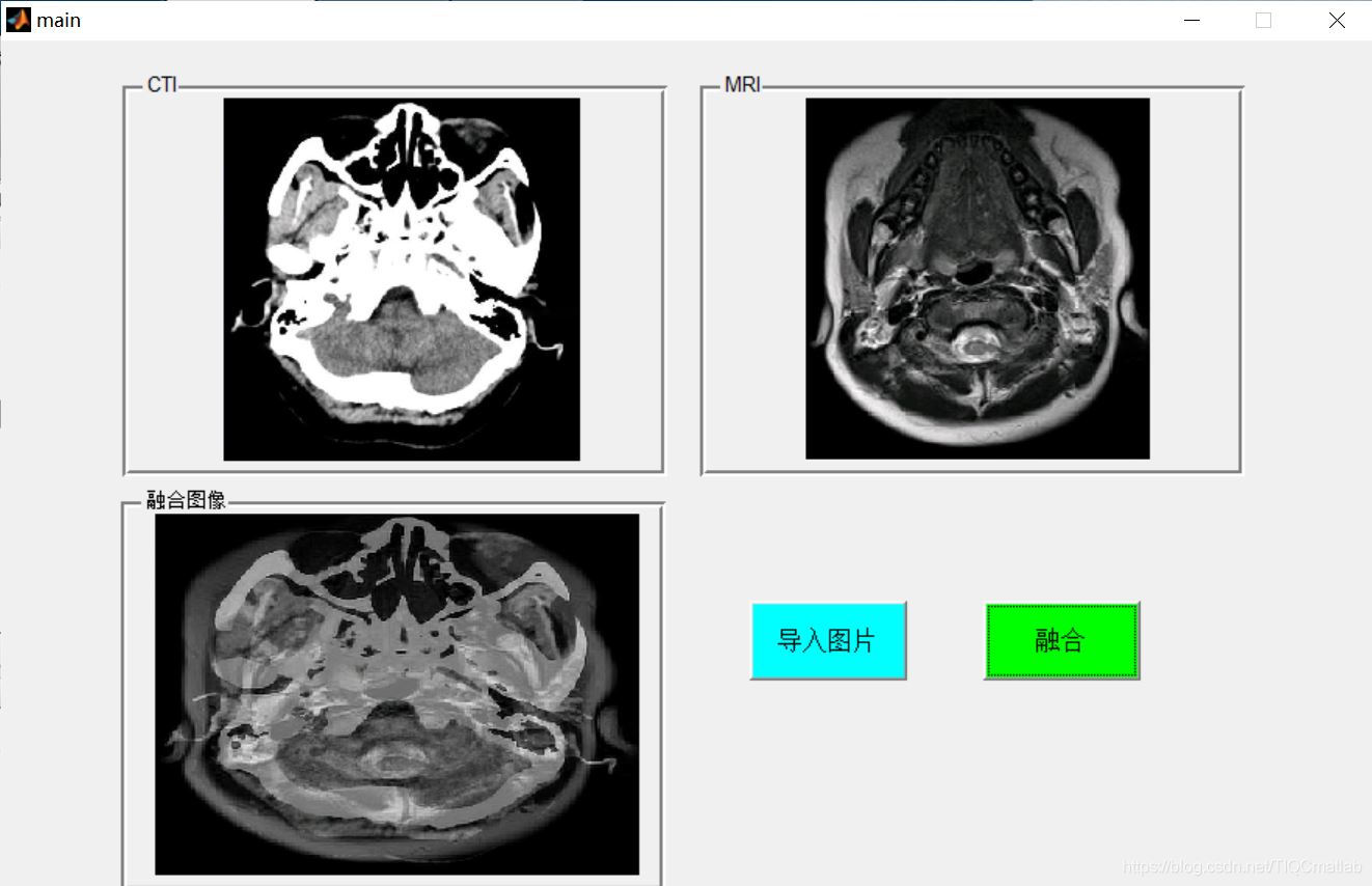 【图像融合】基于matlab GUI小波变换CTI与MRI图像融合【含Matlab源码 782期】_图像压缩_05