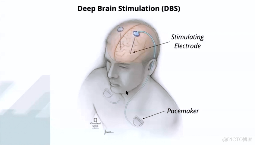 CMU研究人员提出一种新的深部脑刺激方法，可延长帕金森病治疗效果_深度学习_04