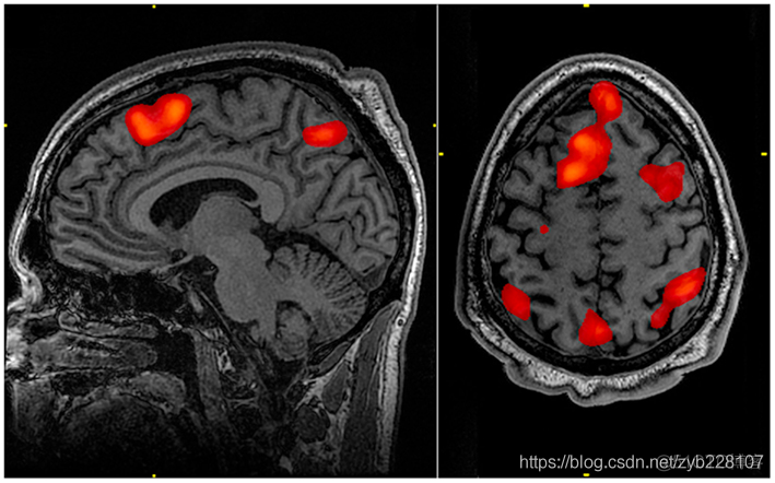 EEG vs MRI vs fMRI vs fNIRS简介_脑机接口_04