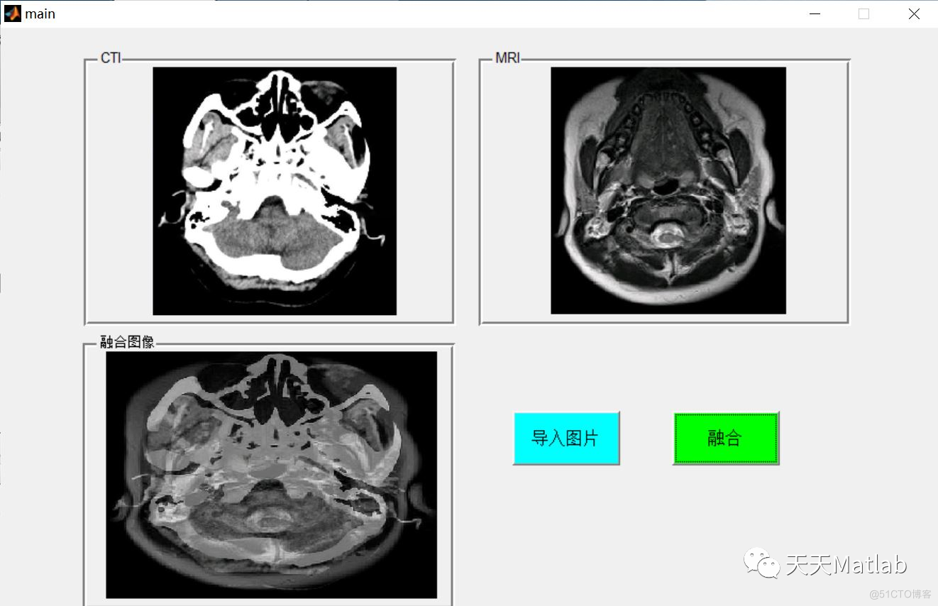 【图像融合】基于小波变换实现CTI与MRI医学图像融合含Matlab源码_医学图像_03
