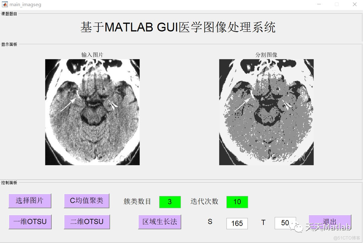 【图像分割】基于均值聚类+OUST+区域生长法实现MRI图像分割附matlab代码_选择图片