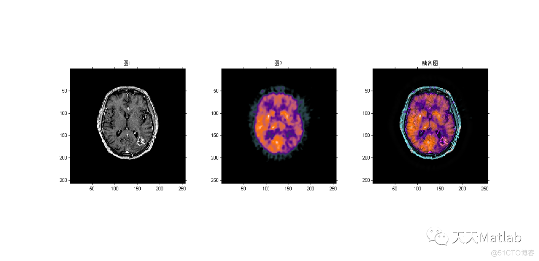 【图像融合】基于NSST结合PCNN实现医学多模态图像融合附matlab代码_图像融合