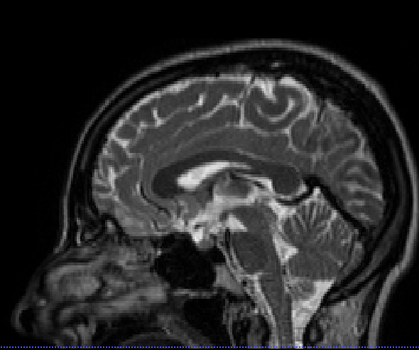介绍一款 MRI&CT 图像预处理强大工具--FSL_sed