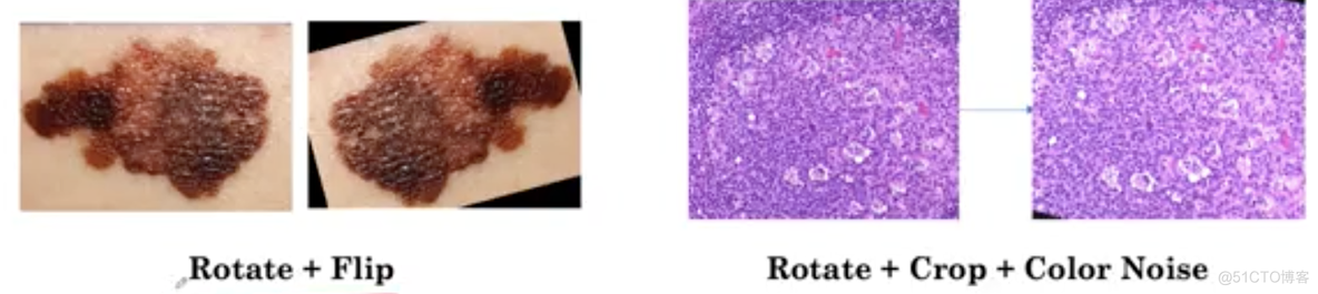 医学图像人工智能专项课程-深度学习用于疾病诊断-第一课第一周13-15节-迁移学习+数据增强_迁移学习_05
