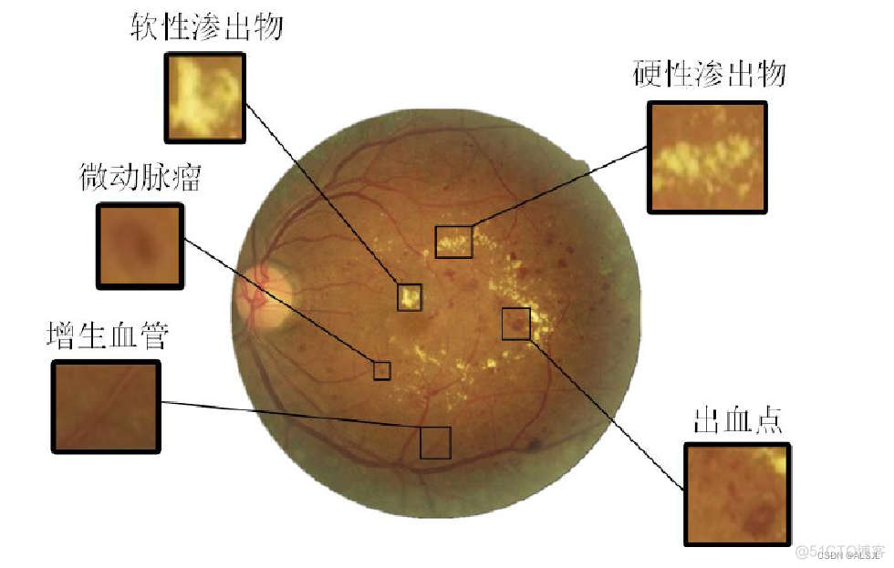 糖尿病眼底图片数据集pytorch 糖尿病眼底照片_数据