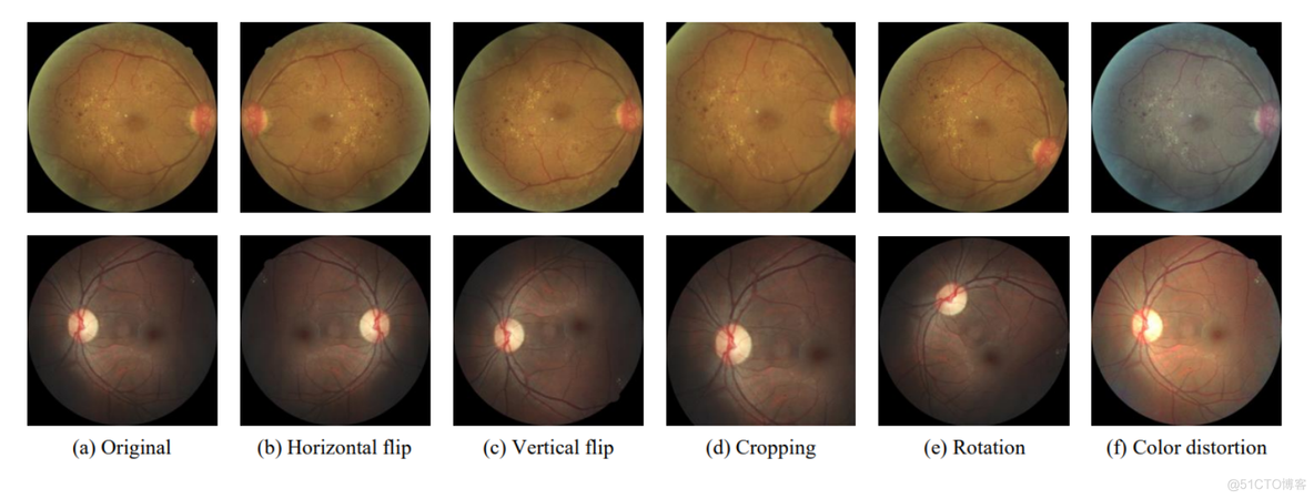 眼底图 + ResNet-50 + 糖尿病视网膜病变分级 + 组件分析_数据_04