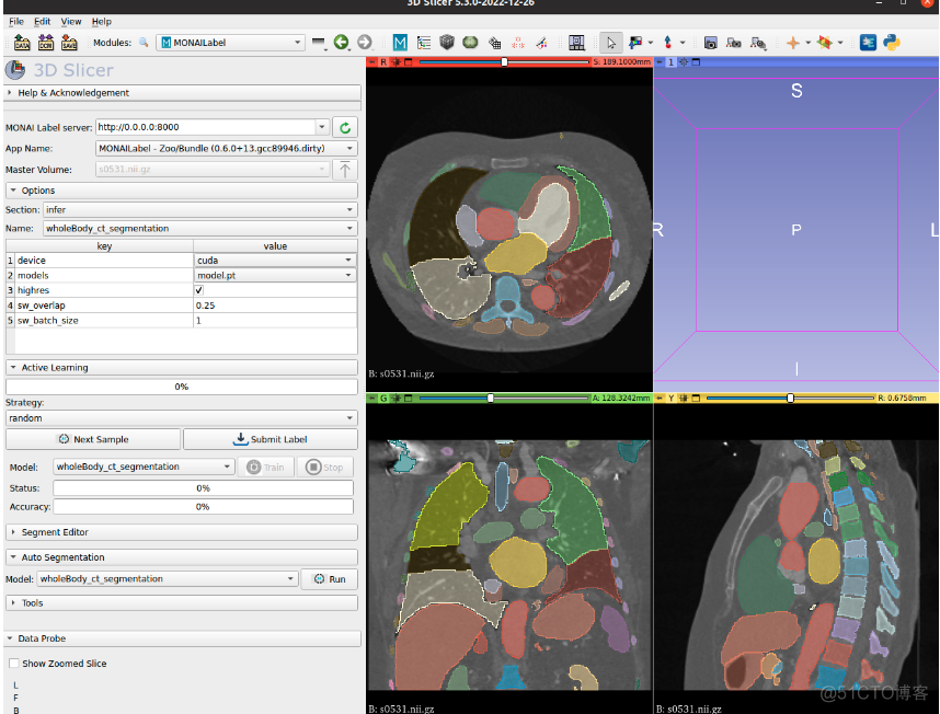 在3D Slicer中使用 Monai Bundle 和 Model Zoo 标注医学影像数据-全身CT器官分割_数据