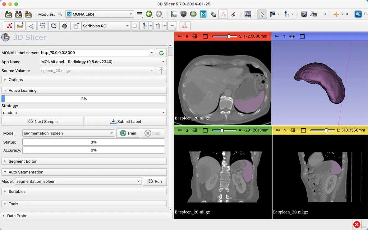 MONAILabel in 3D Slicer 案例1: 在腹部CT中自动分割脾脏_3D