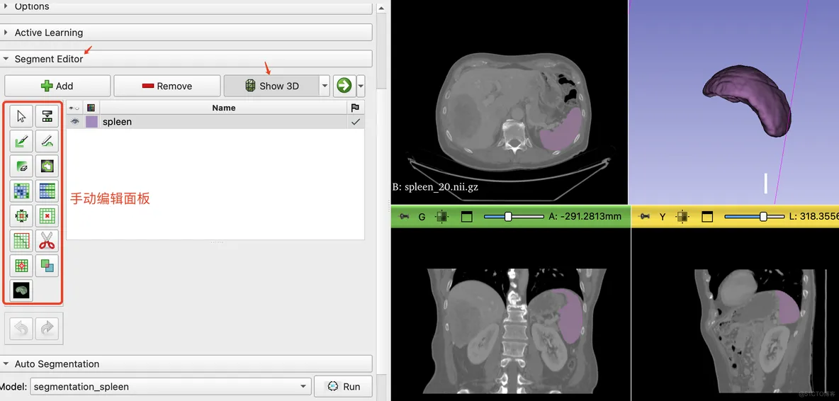 MONAILabel in 3D Slicer 案例1: 在腹部CT中自动分割脾脏_计算机视觉_12