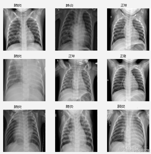 Python贝叶斯卷积神经网络BCNN分类胸部X光图像数据集实例_数据集_04