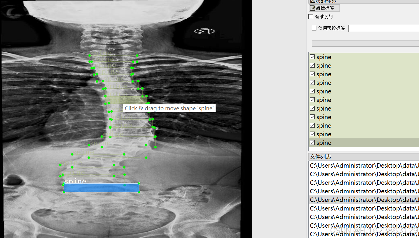 [数据集][目标检测]脊椎检测数据集VOC+YOLO格式1137张1类别_数据集_02