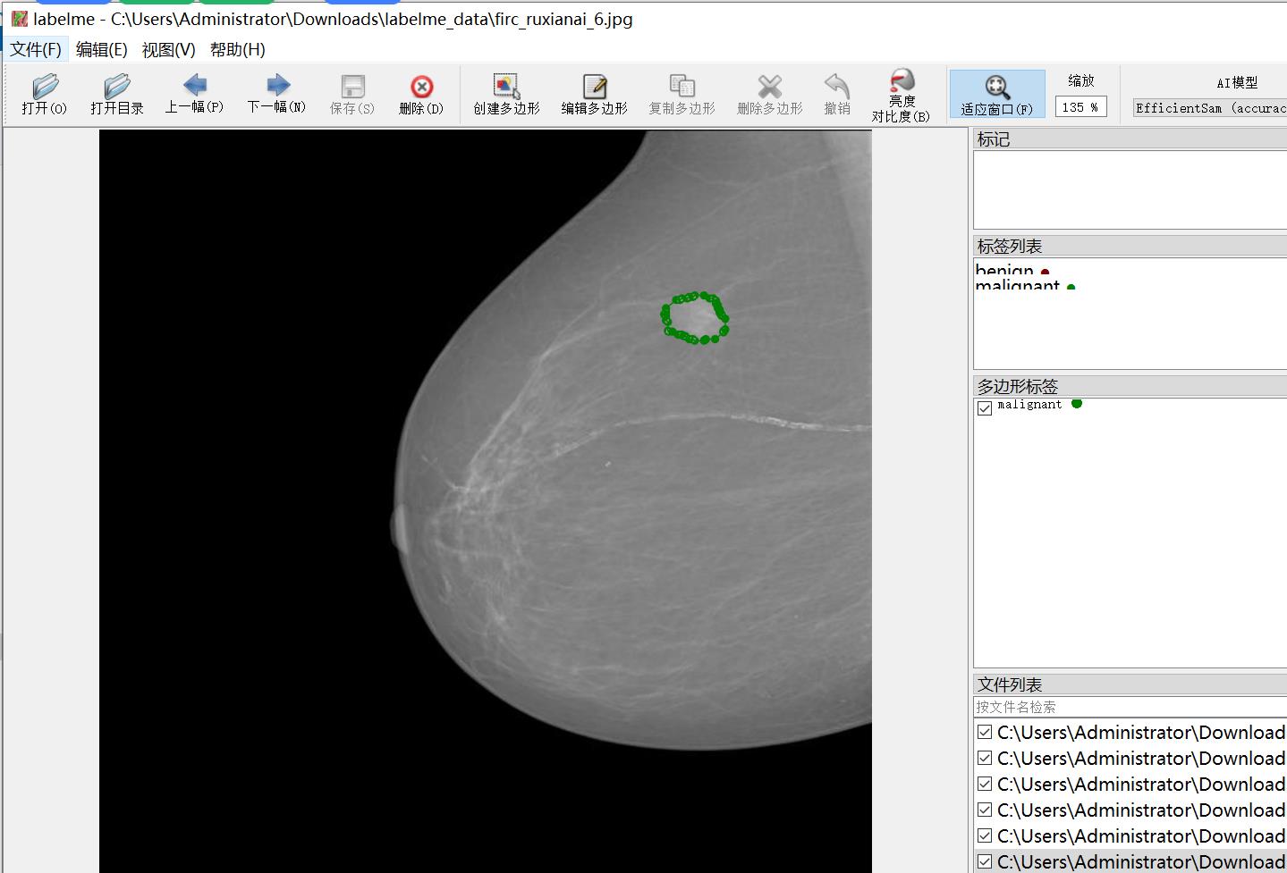 乳腺癌分割数据集labelme格式165张3类别_json数据_02