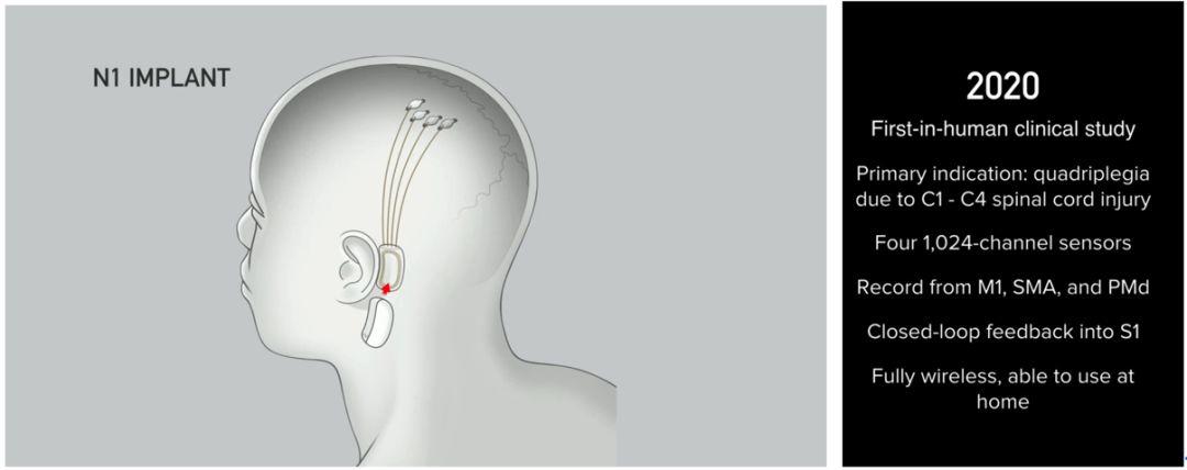 æŒ‘æˆ˜é©¬æ–¯å…‹Neuralinkï¼æ–¯å¦ç¦å…¨æ–°è„‘æœºæŽ¥å£ï¼Œç›´è¿žå¤§è„‘å’Œç¡…åŸºèŠ¯ç‰‡